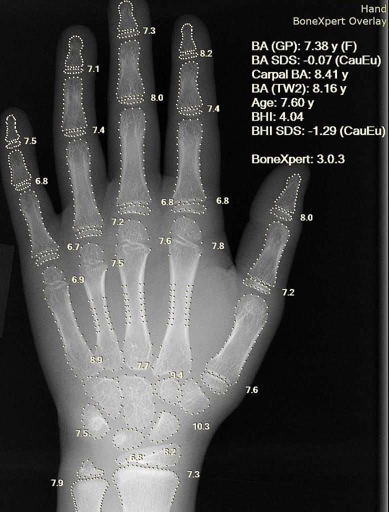 A computer program automatically determines the age of a person's hand bones through an X-ray examination.